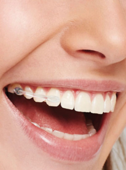 Carriere braces