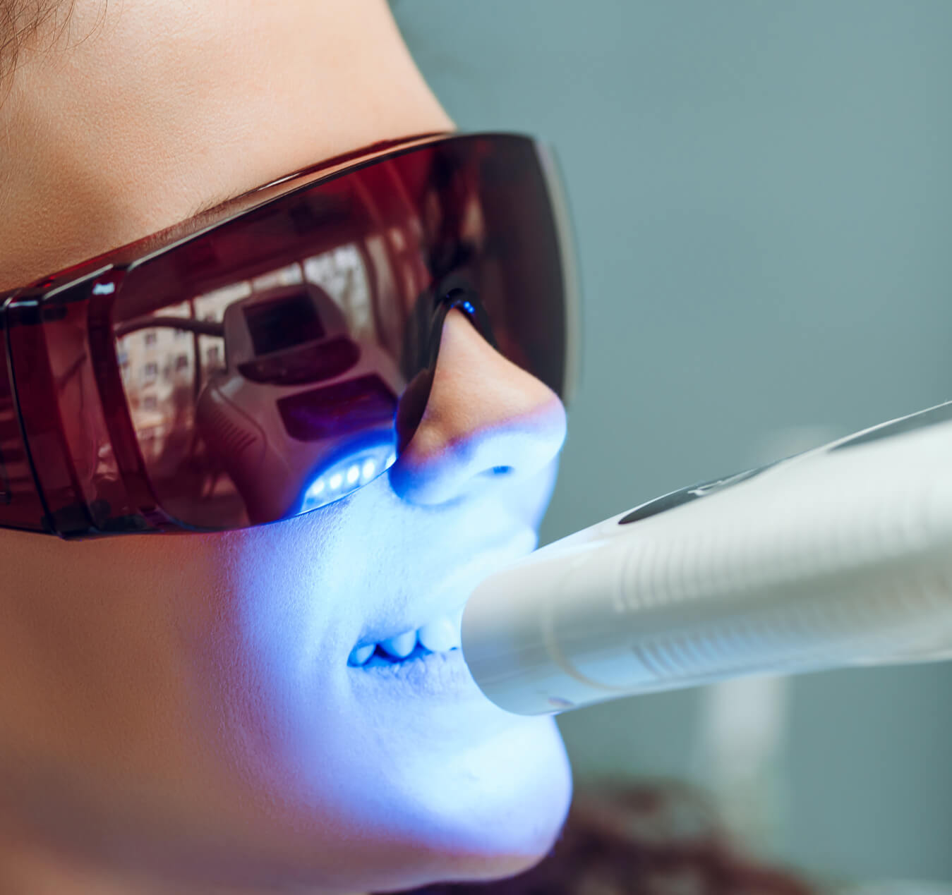 Do I need to whiten my teeth? Do I need to whiten my teeth?