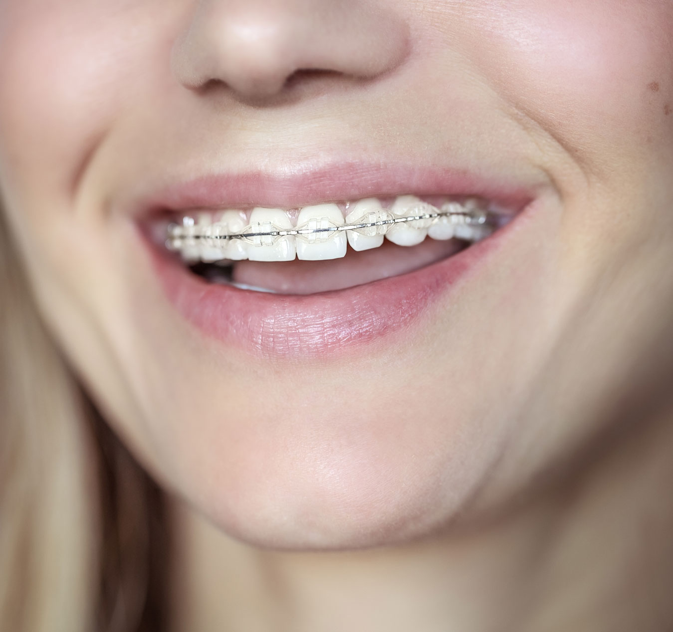 What are ceramic braces? What are ceramic braces?