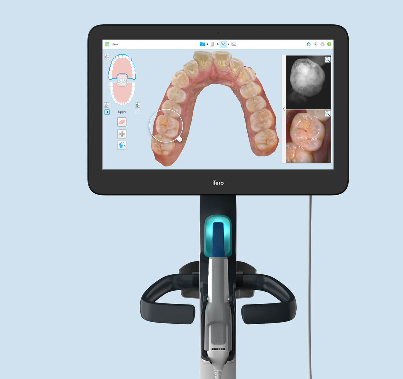 Benefits of the iTero digital scanner Benefits of the iTero digital scanner