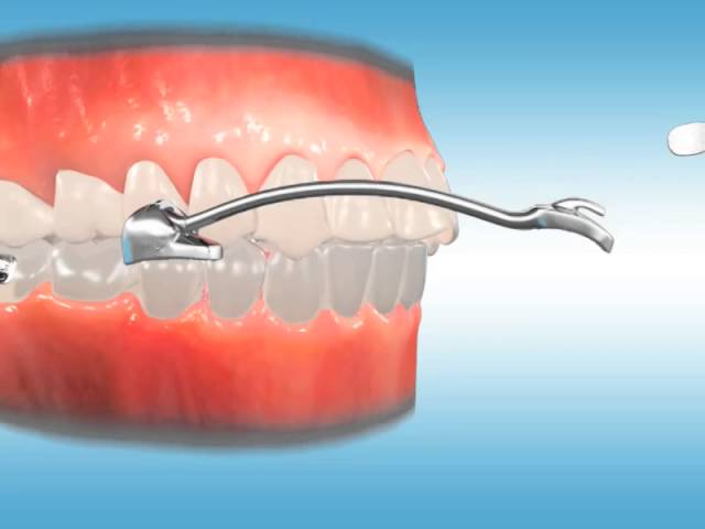 Carriere braces